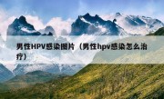 男性HPV感染图片（男性hpv感染怎么治疗）