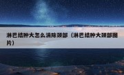 淋巴结肿大怎么消除颈部（淋巴结肿大颈部图片）