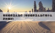 带状疱疹怎么治疗（带状疱疹怎么治疗用什么药效果好）