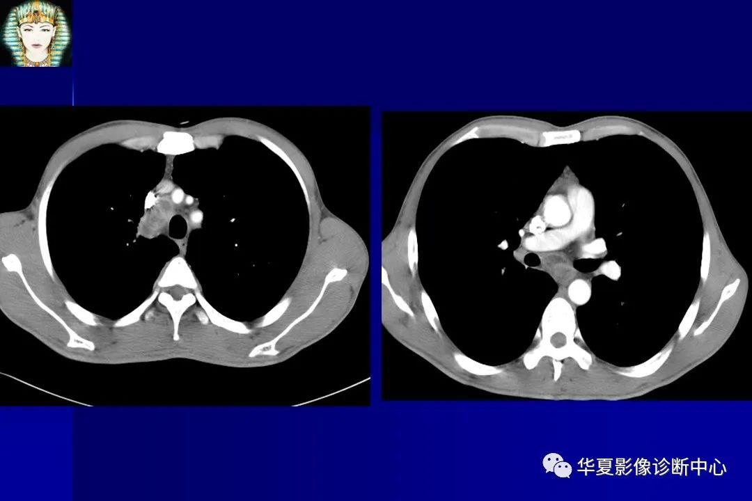 肺结核最新诊断标准详解与应用指南